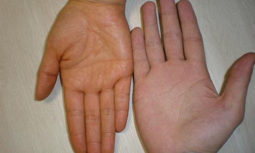 图为:橘黄症 左 与正常人 右 手掌皮肤对比